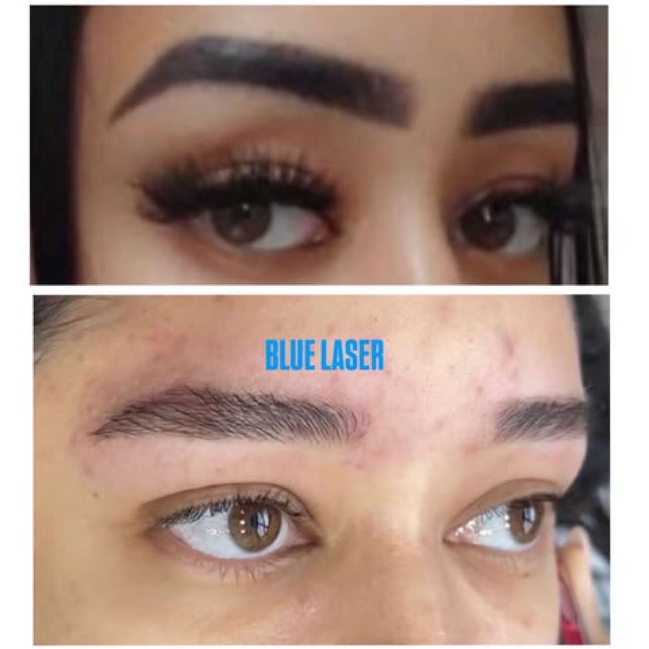Sobrancelha após a remoção publicada pela Blue Laser